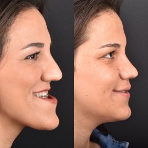 Vorher-nachher-Ergebnis Kieferimplantat bei Dentavie Istanbul Dental Clinic, verbessertes Kinnprofil