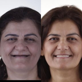 Vorher-nachher-Ergebnis Kieferimplantat bei Dentavie Istanbul Dental Clinic, verbesserte Symmetrie