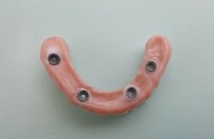 Zdjęcia przed i po Implantacja zębów za pomocą technologii All-on-4 ("wszystko na czterech"). wykonane przez dr. 