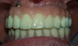 Zdjęcia przed i po Implantacja zębów za pomocą technologii All-on-4 ("wszystko na czterech"). wykonane przez dr. 