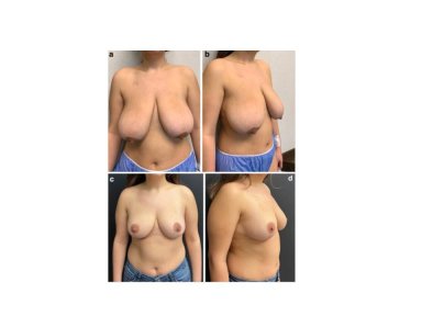 Before and after breast reduction results at Memorial Bahçelievler Hospital, improved contour