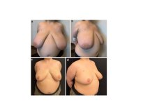 Before and after breast reduction results at Memorial Bahçelievler Hospital, improved contour