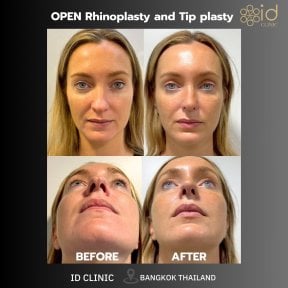 before-after photo ultrasonic-rhinoplasty