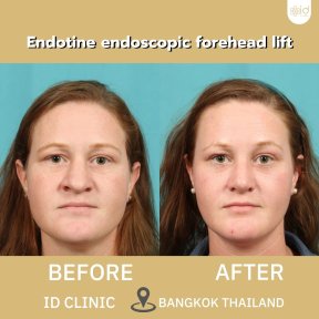 Before and after endotine endoscopic forehead lift results at ID Clinic Bangkok