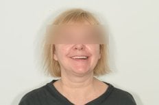 Resultado de implantes dentales All-on-4 en Unident Clinic: sonrisa y restauración dental mejoradas