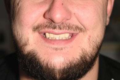 Resultado de implantes dentales All-on-4 en Unident Clinic: sonrisa y dientes restaurados