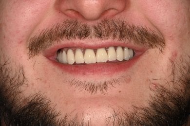 Resultado de implantes dentales All-on-4 en Unident Clinic: sonrisa restaurada y natural