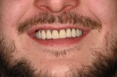 Resultado de implantes dentales All-on-4 en Unident Clinic: sonrisa restaurada y natural