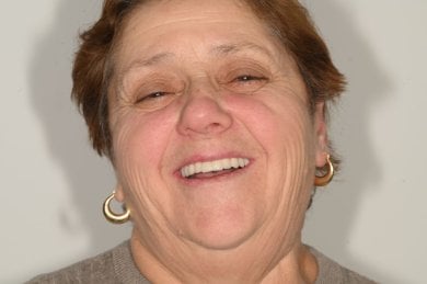 نتيجة زراعة الأسنان في عيادة Unident – ابتسامة محسنة ومظهر أسنان مستعاد