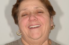 نتيجة زراعة الأسنان في عيادة Unident – ابتسامة محسنة ومظهر أسنان مستعاد