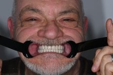 نتيجة زراعة الأسنان في عيادة Unident – ابتسامة محسنة ومظهر أسنان مستعاد