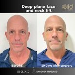 Before and after deep plane face and neck lift results at ID Clinic Bangkok, 10 days post-op