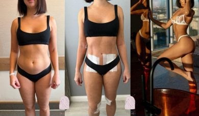 Before and after liposuction results at Dr. MED – visible body contouring and slimmer waist