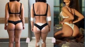 Before and after liposuction results at Dr. MED – visible body contouring and smoother curves