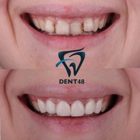 Vorher-nachher-Ergebnis Sofortprothesen bei Dent48 Oral and Dental Health Polyclinics