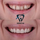 Vorher-nachher-Ergebnis Sofortprothesen bei Dent48 Oral and Dental Health Polyclinics