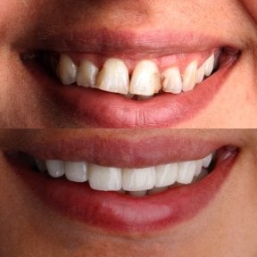 Vorher-nachher-Ergebnis Sofortprothesen bei Dent48 Oral and Dental Health Polyclinics