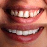 Vorher-nachher-Ergebnis Sofortprothesen bei Dent48 Oral and Dental Health Polyclinics