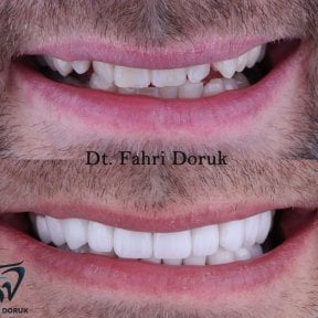 Vorher-nachher-Ergebnis Sofortprothesen bei Dent48 Oral and Dental Health Polyclinics