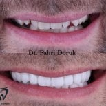 Vorher-nachher-Ergebnis Sofortprothesen bei Dent48 Oral and Dental Health Polyclinics