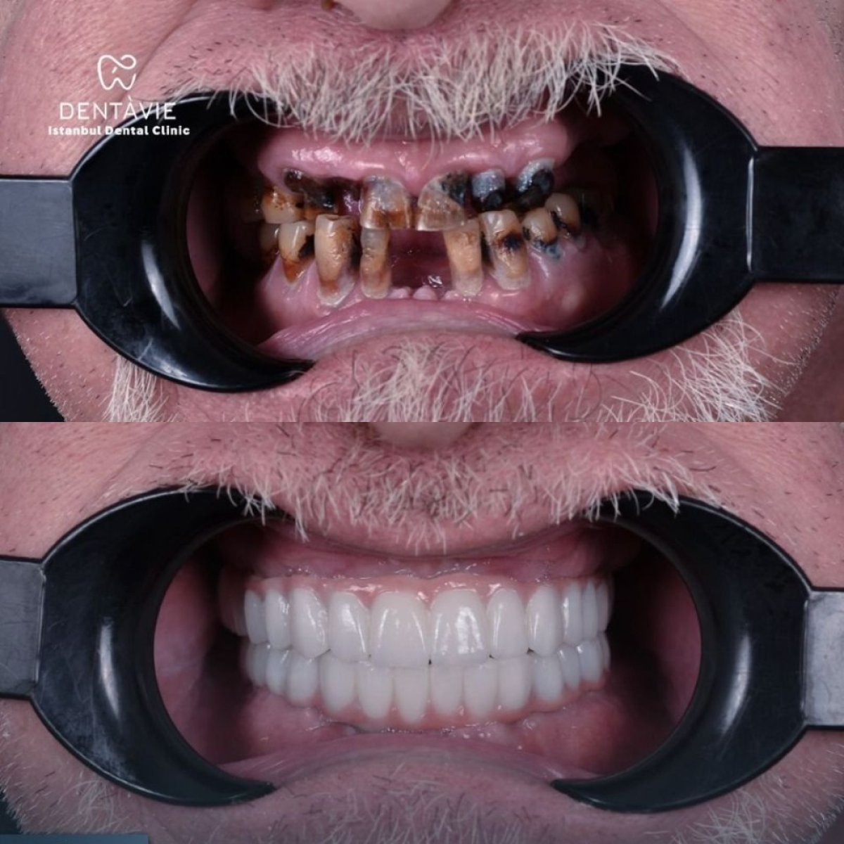 Resultados antes y después de implantes dentales en Dentavie Istanbul Dental Clinic, restauración total de la sonrisa