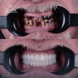 Before and after dental implant results at Dentavie Istanbul Dental Clinic, full smile restoration
