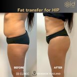 Before and after fat transfer for hip at ID Clinic Bangkok, visible body contouring result