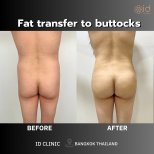 Before and after fat transfer to buttocks at ID Clinic Bangkok, visible contour enhancement result