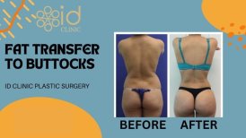 Before and after fat transfer to buttocks at ID Clinic Bangkok, visible contour improvement result