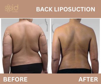 Before and after back liposuction results at ID Clinic Bangkok, visible fat reduction and contour