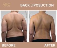 Before and after back liposuction results at ID Clinic Bangkok, visible fat reduction and contour