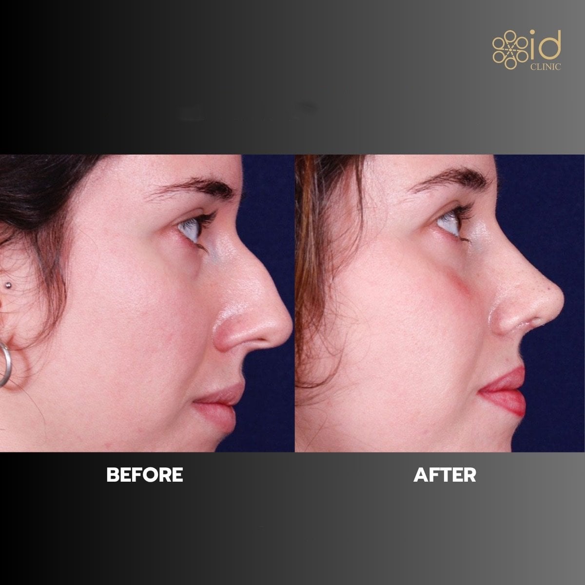 Resultados de rinoplastia antes y después en ID Clinic Bangkok, nariz de aspecto natural