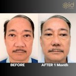 Before and after rhinoplasty results at ID Clinic Bangkok, visible nose reshaping after 1 month