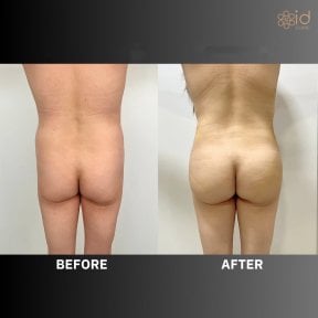 Before and after liposuction results at ID Clinic Bangkok, improved body contour and waistline