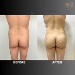 Before and after liposuction results at ID Clinic Bangkok, improved body contour and waistline