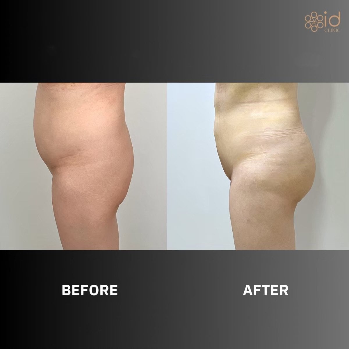 Resultados de liposucción antes y después en ID Clinic Bangkok, mejora visible del contorno corporal