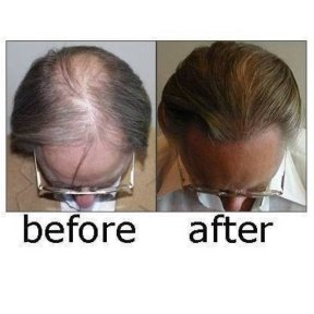 Before and after hair transplant results at ID Clinic Bangkok, restored fuller hairline