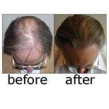 Before and after hair transplant results at ID Clinic Bangkok, restored fuller hairline