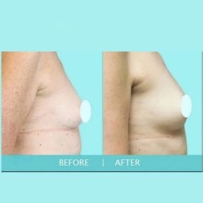 Before and after breast augmentation results at ID Clinic Bangkok, enhanced breast volume