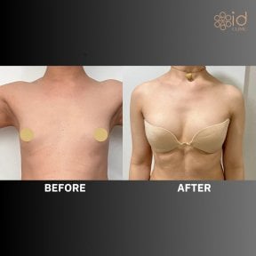 Before and after breast augmentation results at ID Clinic Bangkok, enhanced breast volume