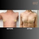 Before and after breast augmentation results at ID Clinic Bangkok, enhanced breast volume