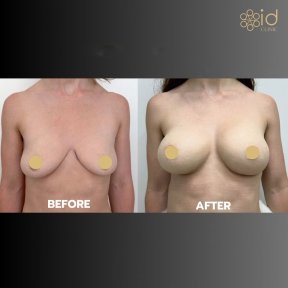 Before and after breast augmentation with fat transfer results at ID Clinic Bangkok