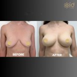Before and after breast augmentation with fat transfer results at ID Clinic Bangkok