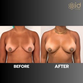 Before and after breast augmentation with fat transfer results at ID Clinic Bangkok