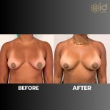 Before and after breast augmentation with fat transfer results at ID Clinic Bangkok