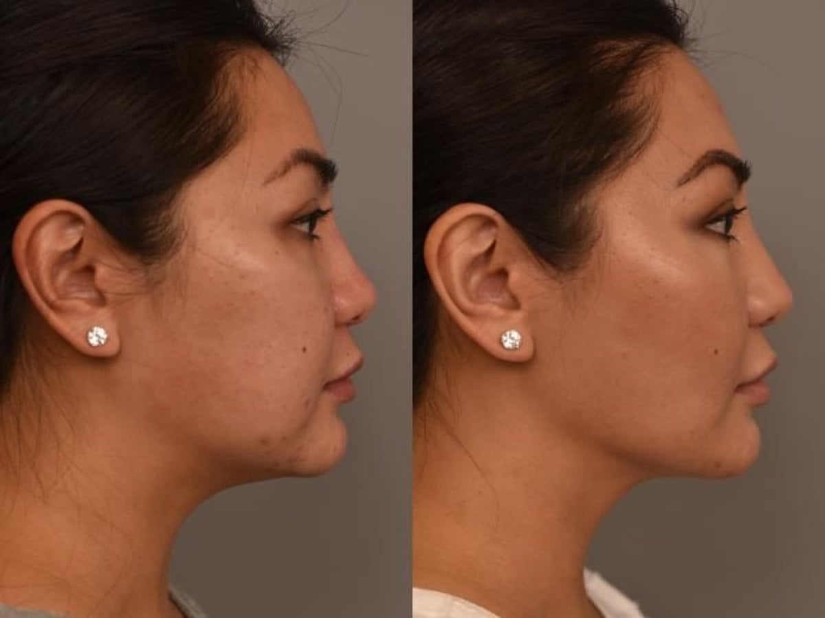 Resultados antes y después de implante de mentón en Dr. Alexandro Aguilera - Plastic Surgery, perfil mejorado