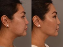 Vorher-nachher-Ergebnis Kinnimplantat bei Dr. Alexandro Aguilera - Plastic Surgery, verbessertes Profil