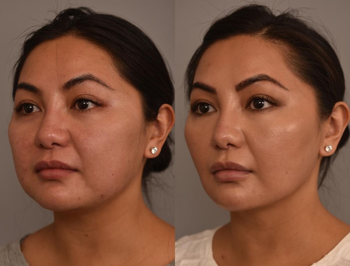 نتائج قبل وبعد زراعة الذقن في Dr. Alexandro Aguilera - Plastic Surgery، تحسين تحديد الذقن