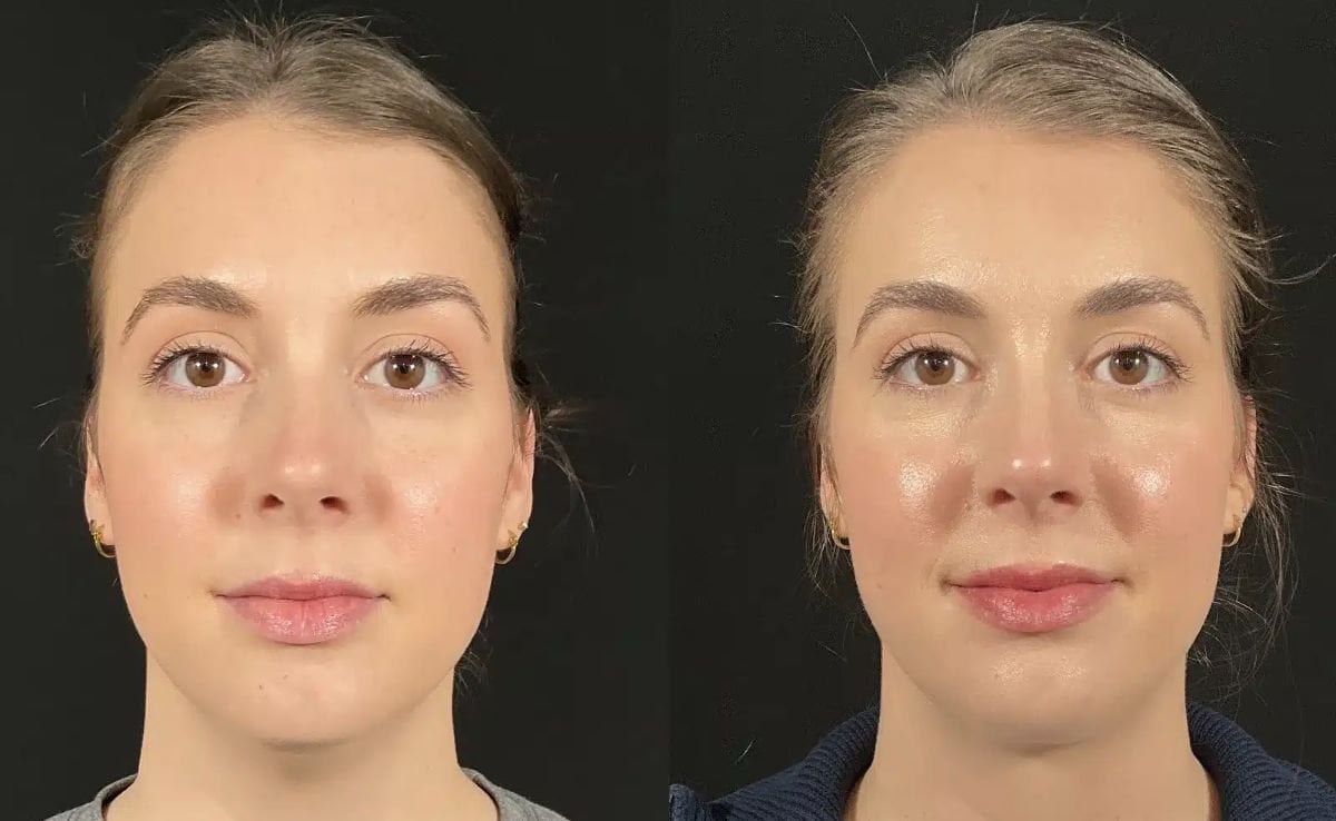 Resultados antes y después de implante de mentón en Dr. Alexandro Aguilera - Plastic Surgery