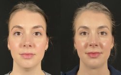 Vorher-nachher-Ergebnis Kinnimplantat bei Dr. Alexandro Aguilera - Plastic Surgery, Kontur